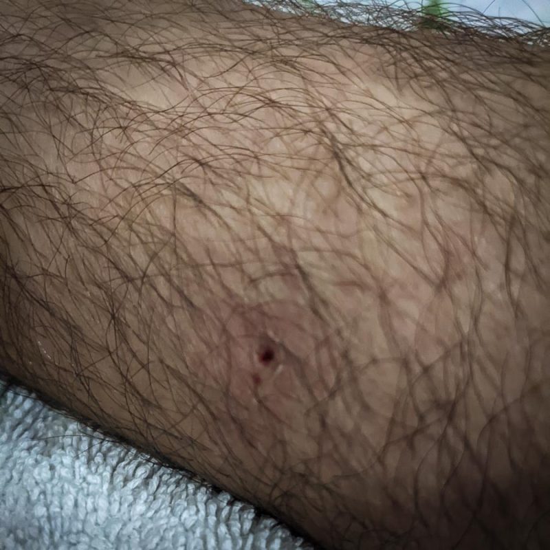 Tristan Balme dog bite in india